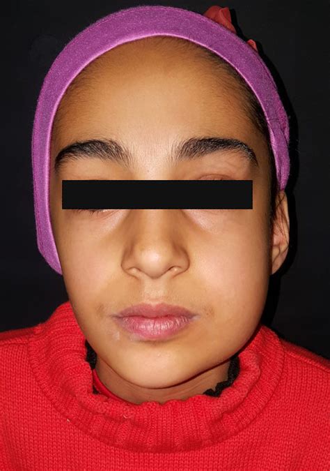 Swelling Involves The Left Cheek And The Lower Jaw With Intact