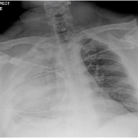 Chest X Ray With Complete Opacification Of The Right Hemithorax