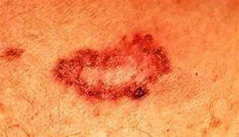 Skin Cancer Causes Symptoms And Treatment Health And Beauty