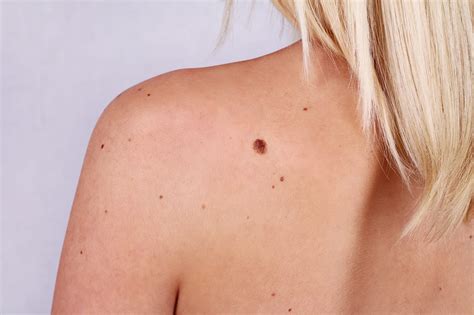 What Are The Different Types Of Skin Moles Beauty Bism