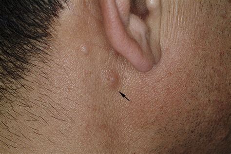 Multiple Papules And Nodules On The Face And Neck Caused By The Larvae