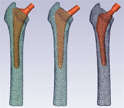 The Three Models Of Cementless Hip Stems Inside The Femoral