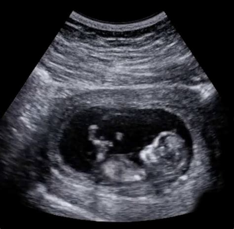 Early Pregnancy Scan Is My Baby A Raspberry Or A Lemon Ultrascan