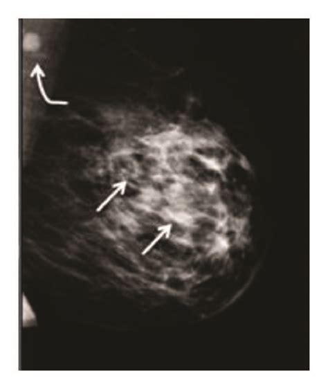 Mammogram Images Of A Fatty Breast And A Heterogeneously Dense Breast