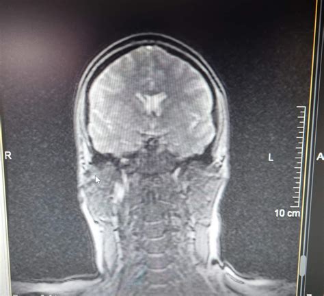 MRT Schädel? (Gesundheit und Medizin, Gehirn)