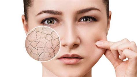 How To Treat Dehydrated Skin Vs Dry Skin Florozone