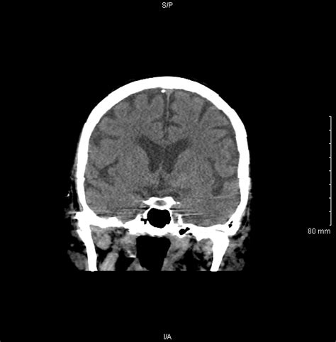 Ct scan brain is also known as ct scan head. Interpreting A Non-Contrast Head CT Scan - Stepwards