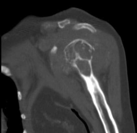 Renal Osteodystrophy Radiology Reference Article Radiopaedia Org