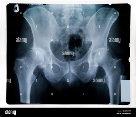 X Ray Of Male Pelvis With Worn Hip Joint Stock Photo Alamy