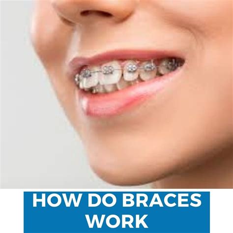 How Do Braces Work A Completed Guide Dental Pickup