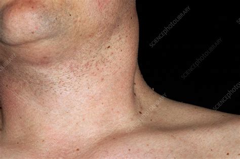 Neck Cancer Spread From The Tongue Stock Image C0051898 Science