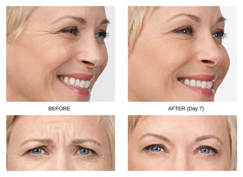 It is not uncommon for patients to wonder whether or not they can continue botox treatments over an extended period of time or if they should take a break between treatments. BOTOX - Auburndale, FL - Dr. Frederick Thurston
