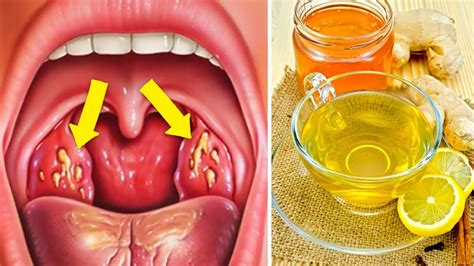 How To Cure Tonsillitis Fast And Naturally Natural Cures