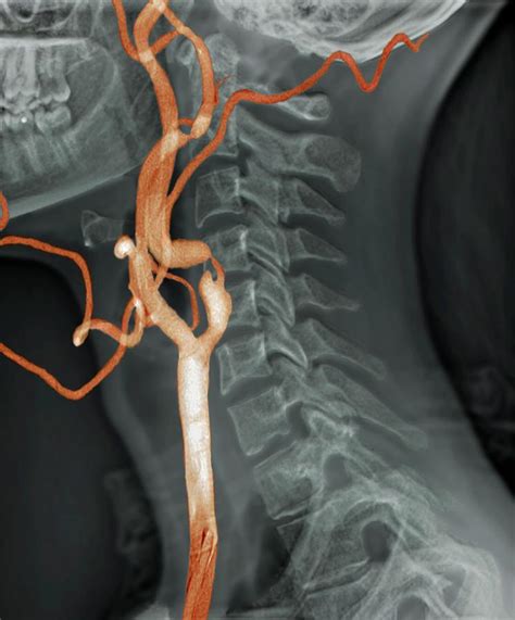 Stenosis Of Carotid Artery Photograph By Zephyrscience Photo Library
