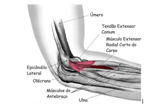 Sintomas De Epicondilite Lateral Do Cotovelo