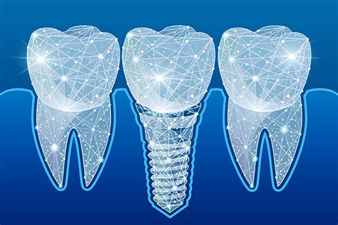 Preventing Complications After Getting Dental Implants