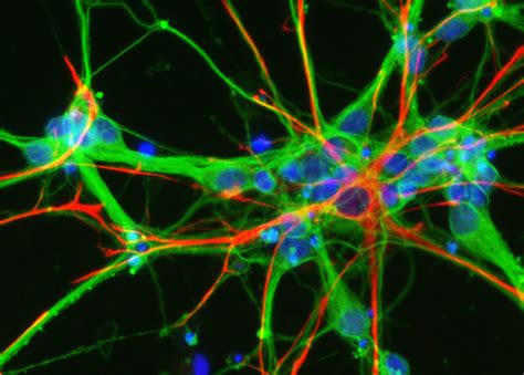 C9orf72 Y Su Papel Central En Neurodegeneración Blog Palex