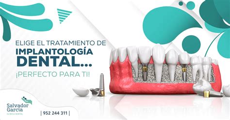 Implantes Dentales Cu L Es El M S Apropiado Para Ti