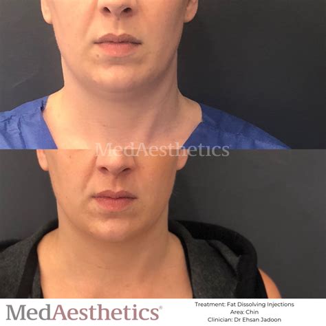 Fat Dissolving Injections Perth Double Chin Reduction Medaesthetics
