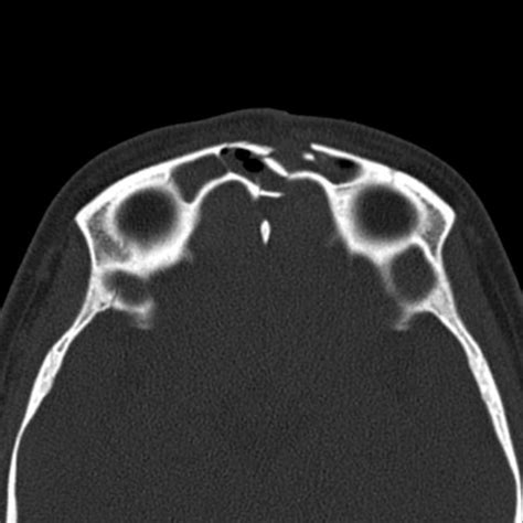 Radiology department of the university in this review we present the normal axial and coronal anatomy of the temporal bone by scrolling through the images. Frontal sinus fracture | Radiology Case | Radiopaedia.org