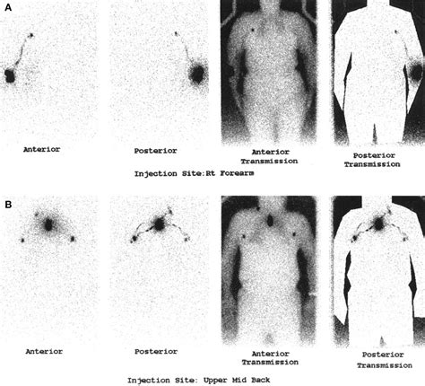 Whole Body Lymphoscintigraphy Using Transmission Scans
