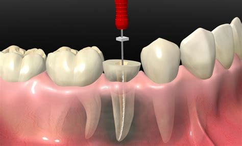 Tips To Follow After Root Canal Treatment Elite Dental Care Tracy
