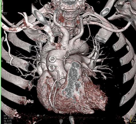 Ccta Severe Coronary Artery Disease With Quadruple Bypass Grafts
