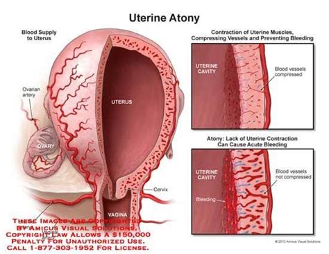 Boggy Uterus What Is It Causes Treatment And More 40 Off