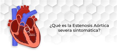 Qué es la Estenósis Aórtica Cardiología Estructural