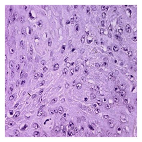 Malignant Squamous Cell Carcinoma Arising From The Epidermal Cyst With
