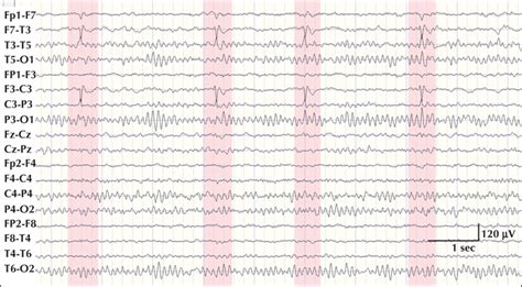 John Libbey Eurotext Epileptic Disorders Benign Rolandic Epilepsy