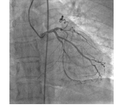 Right Anterior Oblique View Of The Coronary Angiography Showing A