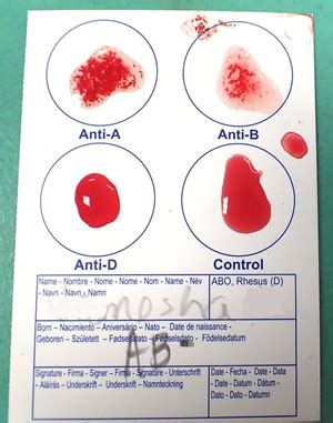 Shows how blood typing is done using an eldoncard. Blood Typing Using EldonCards