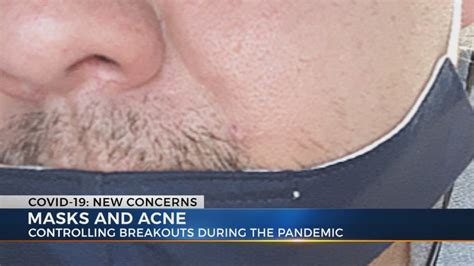How To Deal With Acne Caused By Wearing Face Masks Wkrn News 2