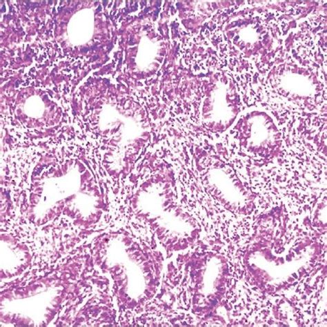 Photomicrograph Showing Endometrial Glands With Complex Hyperplasia
