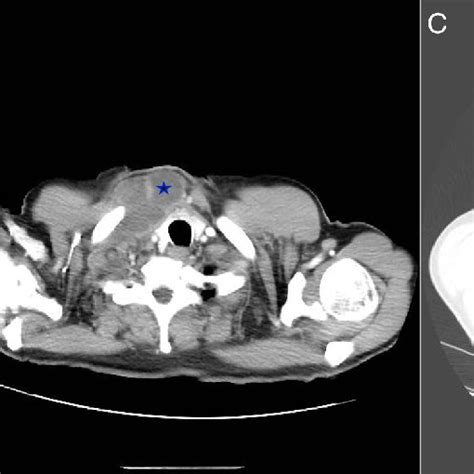 Ab Axial Computed Tomography Ct Scans Showing Complete Resolution