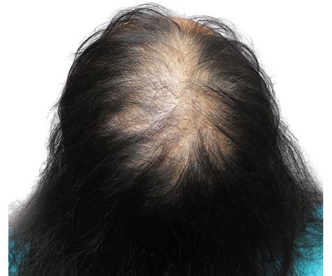Thinning Hair Top Of Head