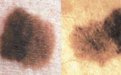The Difference Between Melasma And Other Skin Spots The Healthy