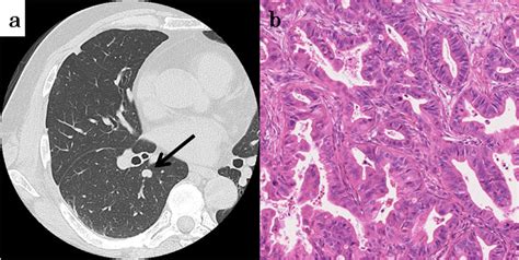 Chest Computed Tomography Revealed A 09 Cm Nodule Coin Lesion In The