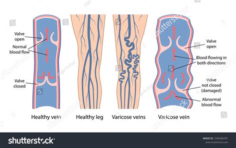 Varicose Veins Image Healthy Diseased Legs Stock Vector Royalty Free