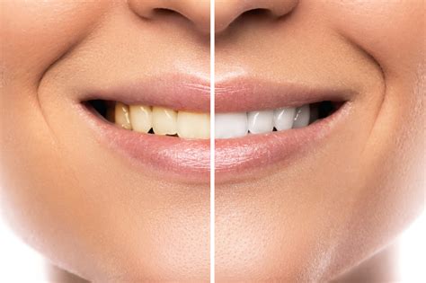 Orange Peel Teeth Whitening And 7 Other Weird Ways To Naturally Whiten