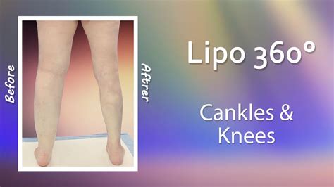 Leg Liposuction Results Lipo 360° Cankles And Knees High Definition Expert Dr Thomas Su