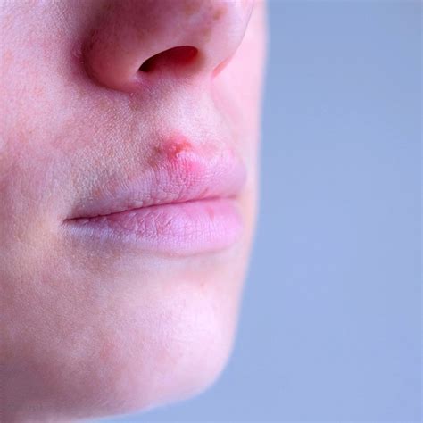 Herpes Blister On Lip Treatment Lips Makeupview
