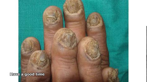 Fingernail Fungus Youtube