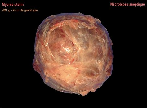Extent of operation depends on uterus size, nodosity size and woman age. Myome (fibrome) utérin en état de nécrobiose aseptique ...