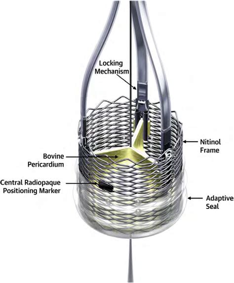 The Lotus Valve System The Bioprosthetic Aortic Valve Implant