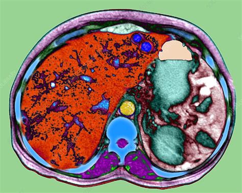The remaining number can be divided into exocrine tumours. Metastatic pancreatic cancer, CT scan - Stock Image - M134 ...
