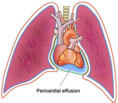 Pericardial Effusion Causes Symptoms Diagnosis Prognosis Treatment