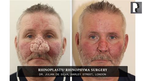My Life Changing Experience Of Nose Surgery Rhinoplasty Rhinophyma