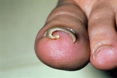 Take Care Of Ingrown Toenails With Foot And Ankle Surgical Associates